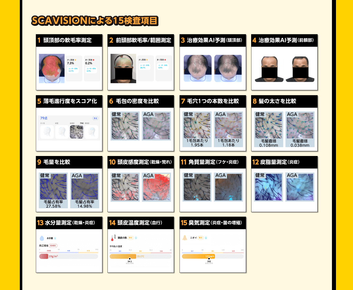 SCAVISIONによる15検査項目 1 頭頂部の軟毛率測定 2 前頭部軟毛率/範囲測定 3 治療効果AI予測（頭頂部） 4 治療効果AI予測（前頭部） 5 薄毛進行度をスコア化 6 毛包の密度を比較 7 毛穴1つの本数を比較 8 髪の太さを比較 9 毛量を比較 10 頭皮感度測定（乾燥・荒れ） 11 角質量測定（フケ・炎症） 12 皮脂量測定（炎症） 13 水分量測定（乾燥・炎症） 14 頭皮温度測定（血行） 15 臭気測定（炎症・菌の増殖）